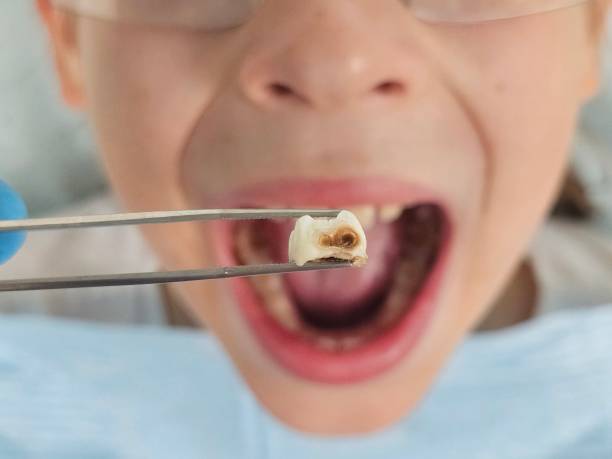 Best Emergency Tooth Extraction in Boulevard Park, WA